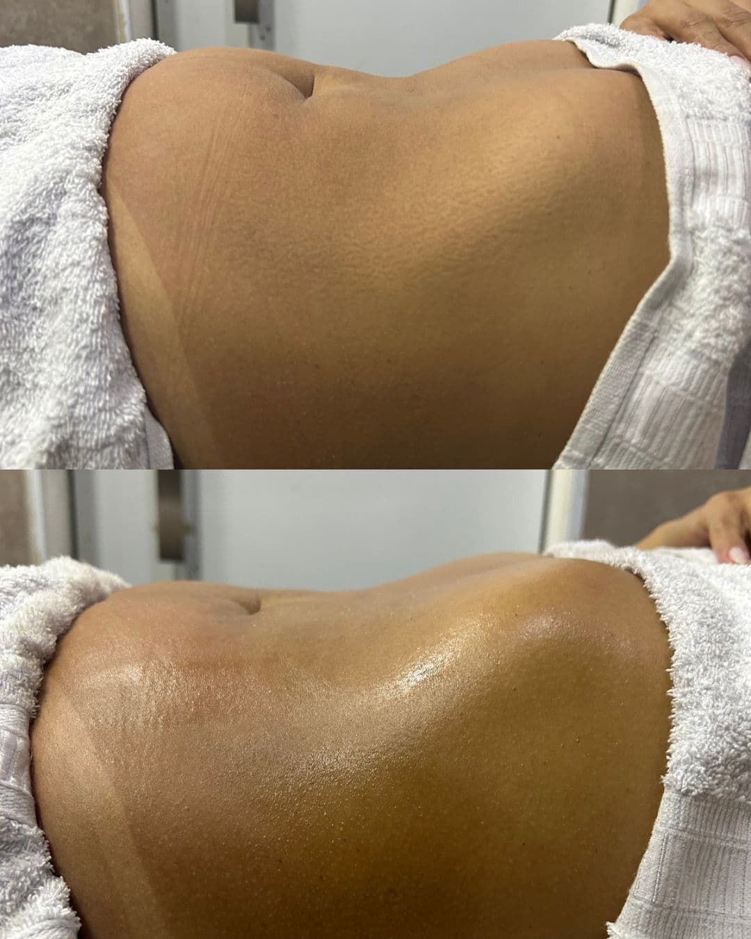 Comparativo real de antes e depois de procedimento realizado por Joyce Macário